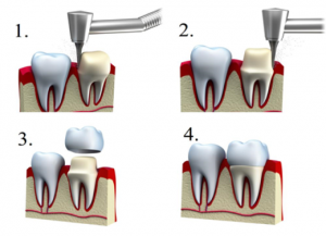 Dantų protezavimas 